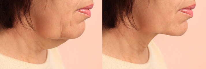 Double chin problem. Collage with photos of mature woman before and after skin tightening treatments on beige background, closeup - obrazy, fototapety, plakaty