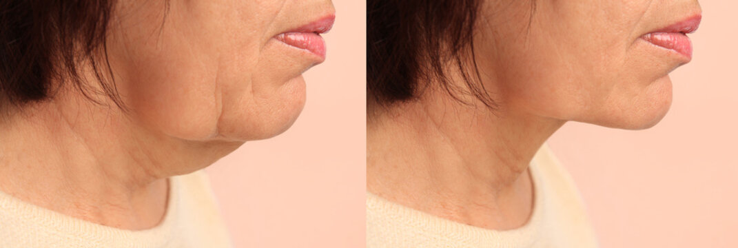 Double chin problem. Collage with photos of mature woman before and after skin tightening treatments on beige background, closeup