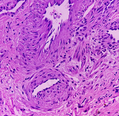 Great toe soft tissue (biopsy).Glomus tumor or Paragangliomas. Microscopically show soft tissue,...