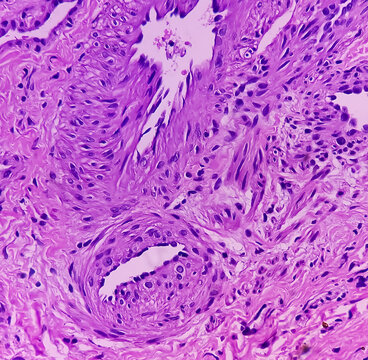 Great Toe Soft Tissue (biopsy).Glomus Tumor Or Paragangliomas. Microscopically Show Soft Tissue, Feature Of Glomus Tumor, Benign But Locally Invasive Tumors.