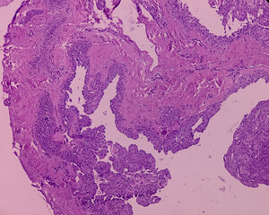 Nodular cystic Hidradenoma. Clear cell hidradenoma, nodular hidradenoma or eccrine acrospiroma,...