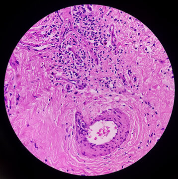 Metastatic olfactory neuroblastoma or esthesioneuroblastoma. Microscopically show reactive change.