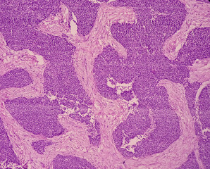 Metastatic olfactory neuroblastoma or esthesioneuroblastoma. Microscopically show reactive change.
