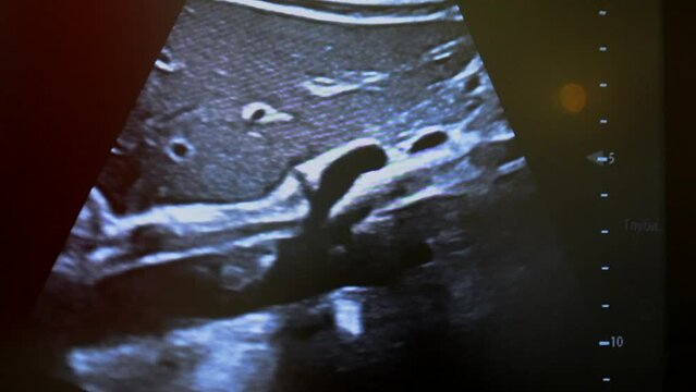 Ultrasound on monitor. Ultrasound image on computer monitor screen close-up. Ultrasound examination. Sonography sonogram. Ultrasonography ultrasonic. Monitoring diagnostic medical healthcare system