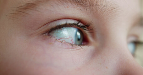 Red Eye Vessels Irritation And Allergy