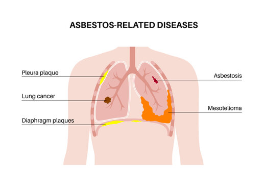 Asbestos related diseases