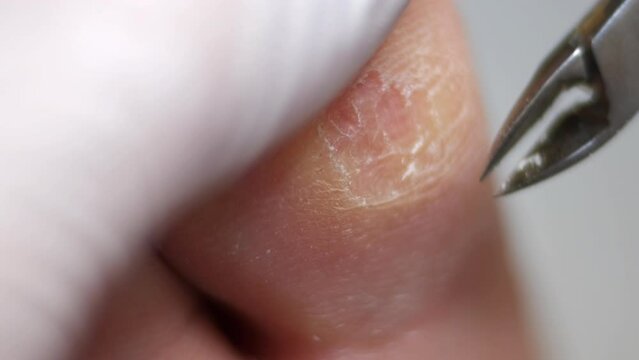Removal of calluses from the sole of the foot with forceps. Skin removal with a tool. Pedicure and podology