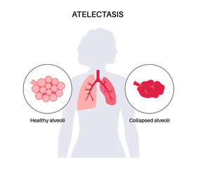 Atelectasis medical poster