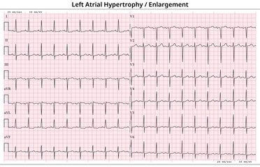 ECG Left Atrial Hypertrophy (LVH) - Left Atrial Enlargement (LAE) - 12 Lead ECG Common Case - 6 Sec/lead - Medical Vector Illustration