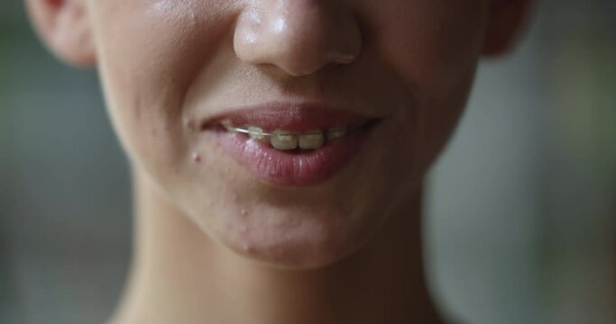 Close up lower part face young attractive teen girl revealing ceramic brackets on teeth, advertise dental braces for straightening, fixing bite issues, improve overall appearance of smile, dental-care