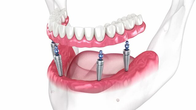 Prostheses supported by 4 implants. Dental 3D animation
