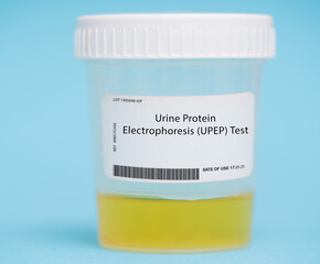 Urine protein electrophoresis (UPEP) test