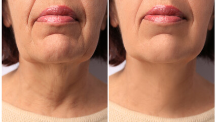 Naklejka na ściany i meble Mature woman before and after skin tightening treatments. Collage with photos, closeup