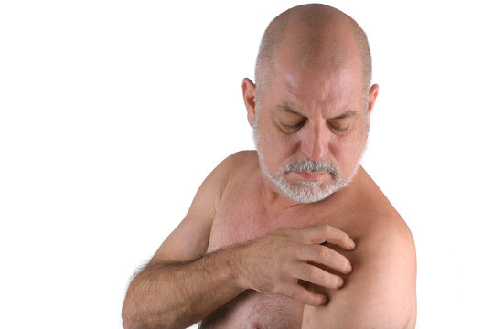 bald adult man showing shoulder skin irritation ringworm dermatological disease
