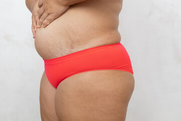 Cropped side view fat, adipose and overweight female in red bikini pulling by hands friable skin...