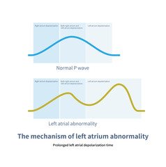 When the left atrium is diseased, the depolarization time of the left atrium is prolonged, and the duration of the sinus P wave on the electrocardiogram increases by more than 120ms.