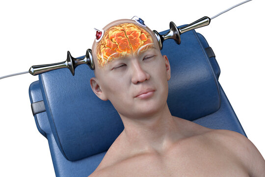 Electroconvulsive therapy machine hi-res stock photography and