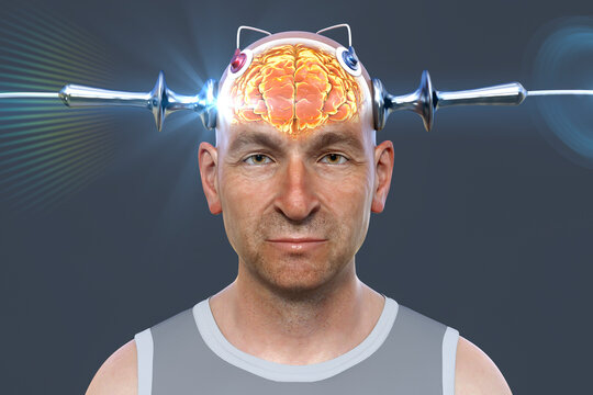 Electroconvulsive therapy, ECT, a treatment involving the use of electrical currents to stimulate the brain, 3D illustration