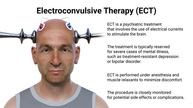 Electroconvulsive therapy, ECT, a treatment involving the use of electrical currents to stimulate the brain, 3D illustration