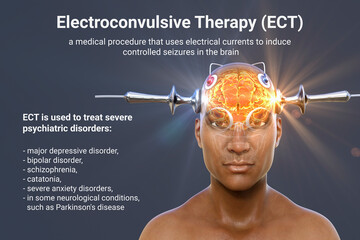 Electroconvulsive therapy, ECT, a treatment involving the use of electrical currents to stimulate the brain, 3D illustration - obrazy, fototapety, plakaty