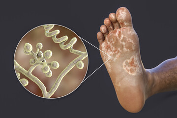 The foot with mycosis, and close-up view of fungi that cause Athlete's foot, 3d illustration - obrazy, fototapety, plakaty