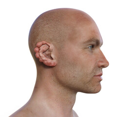 Obraz premium Ear lobomycosis nodules, a chronic skin disease caused by microscopic fungi Lacazia loboi, 3D illustration