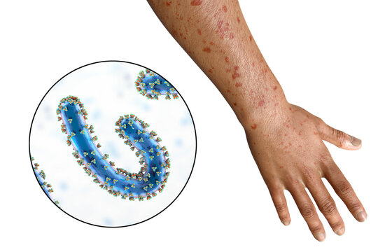 A skin rash on the arm of a patient with Marburg hemorrhagic fever and close-up view of the virus, 3D illustration