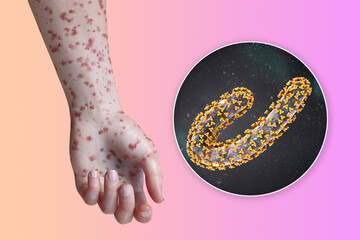 A skin rash on the arm of a patient with Marburg hemorrhagic fever and close-up view of the virus, 3D illustration