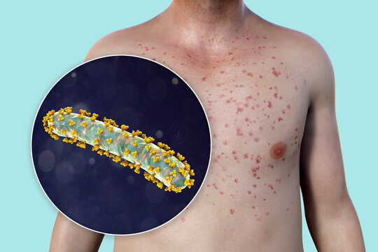 A skin rash on the chest of a patient with Marburg hemorrhagic fever and close-up view of the virus, 3D illustration