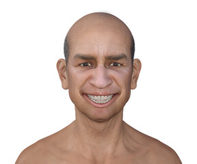 A 3D illustration depicting a person suffering from tetanus, shown with lockjaw symptom, also known as trismus