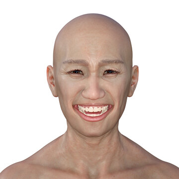 A 3D illustration depicting a person suffering from tetanus, shown with lockjaw symptom, also known as trismus