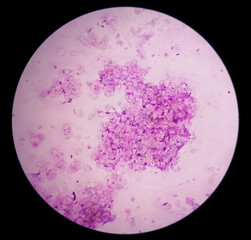 Microscopic analysis showing Epidermal inclusion cyst, swelling of left thigh