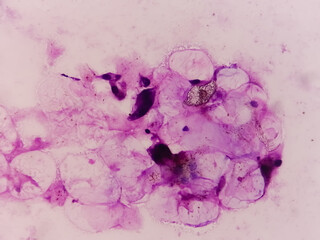 Microscopic analysis showing Epidermal inclusion cyst, swelling of left thigh