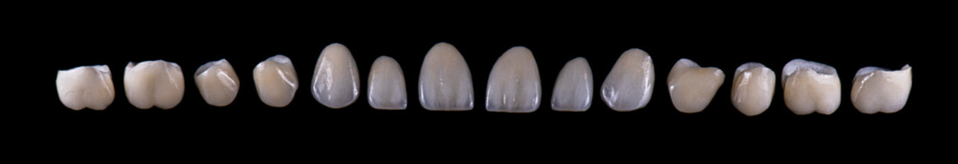 Emax ceramic crowns and veneers like natural teeth