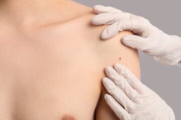 Dermatologist examining mole on young man's shoulder against grey background, closeup