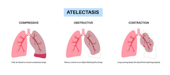 Atelectasis medical poster