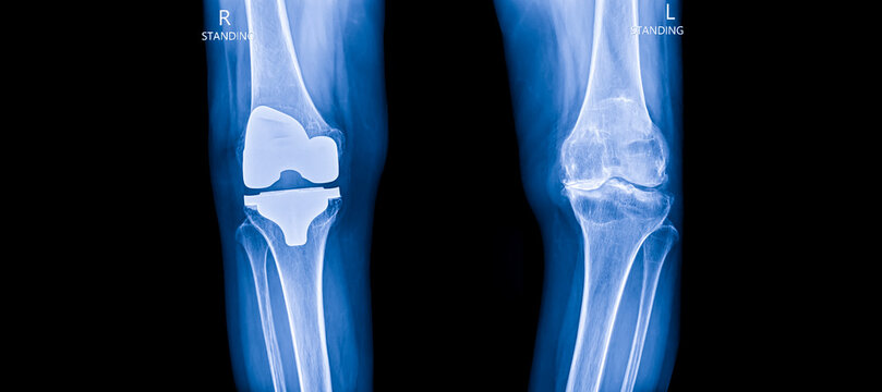 Blue tone of xray image in orthopedic unit inside hospital on black background.X-Ray for diagnosis of knee pain patient.Total knee joint replacement prosthesis technology in osteoarthritis or oa knee.