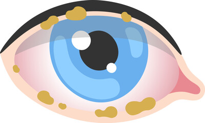 Blepharitis Human Eye Disease