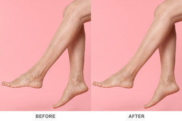 Before and after varicose veins treatment. Collage with photos of woman showing legs on pink...
