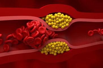 Fully blocked vessel in high level of LDL (bad cholesterol) lipoprotein – Closeup view 3d illustration - obrazy, fototapety, plakaty