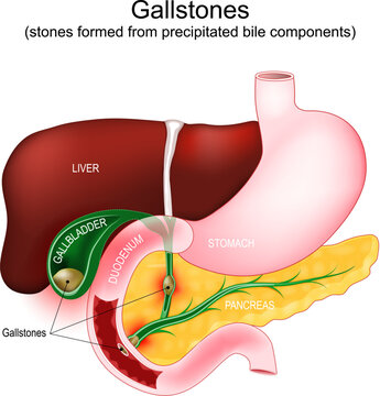 Gallstones. Parts of a digestive system: gallbladder, duodenum, stomach, liver, and pancreas.