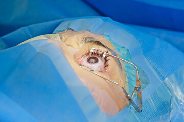 ophthalmology eye surgery excimer laser