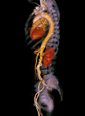 CTA whole aorta 3D rendering.