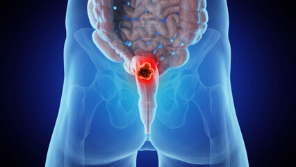 3d medical illustration of rectal cancer - 596363713