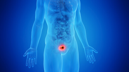 3d medical illustration of bladder cancer