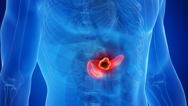 3D Rendered Medical Illustration of Male Anatomy - Pancreatic Cancer.
