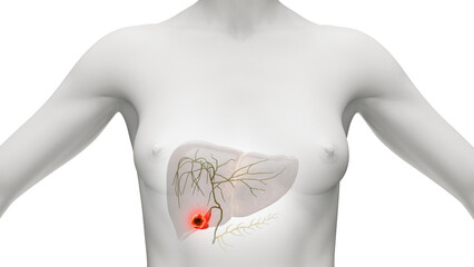 3d illustration of gallbladder cancer