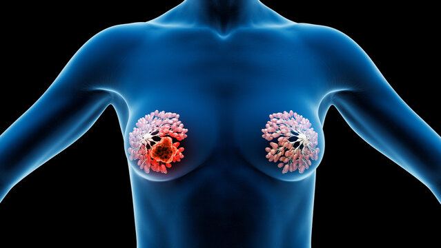 3d rendered medical illustration of breast cancer