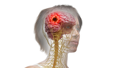 3d rendered medical illustration of a brain tumor - obrazy, fototapety, plakaty