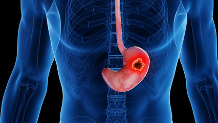 3d rendered medical illustration of stomach cancer - obrazy, fototapety, plakaty